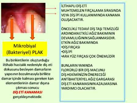 saglikli dis eti nasil olmalidir dr tuncay akdoganli