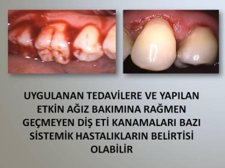 saglikli dis eti nasil olmalidir dr tuncay akdoganli