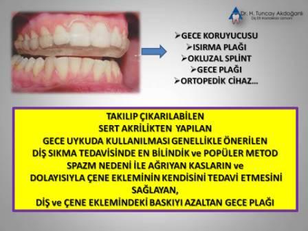 Çene eklemi rahatsızlıklarında kullanılan gece koruyucusu