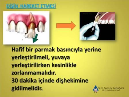 Dişin yerinden hareket etmesi