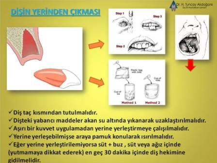 dişin yerinden çıkması