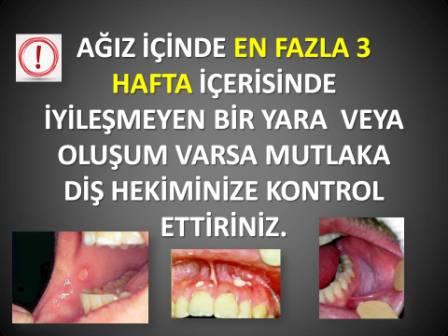 3 hafta içinde iyileşmeye ağız içi yaralar