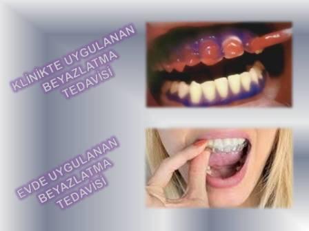 Diş beyazlatma nasıl yapılır ?