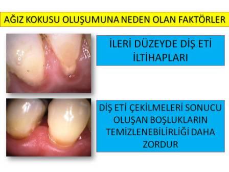 agiz kokusu ve guncel oneriler dis hekimi dr tuncay akdoganli