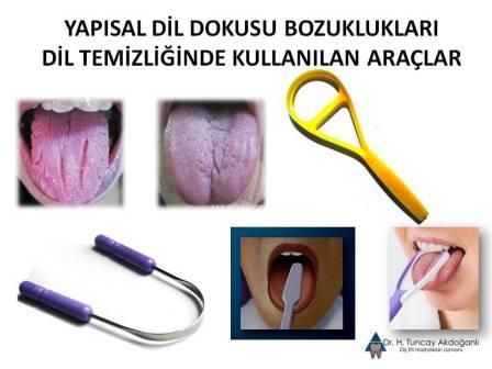 DİL TEMİZLEME