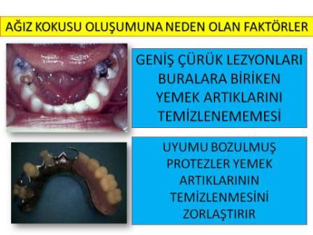 KÖTÜ AĞIZ KOKUSU