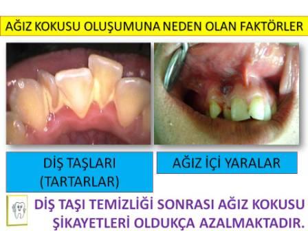 AĞIZ KOKUSU OLUŞTURAN FAKTÖRLER