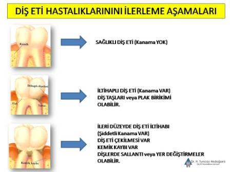 diş eti hastalıklarının ilerlemesi