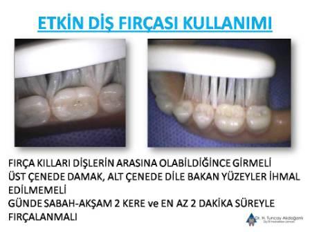 diş fırçasının etkin kullanımı