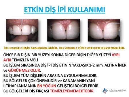 diş ipi kullanımı