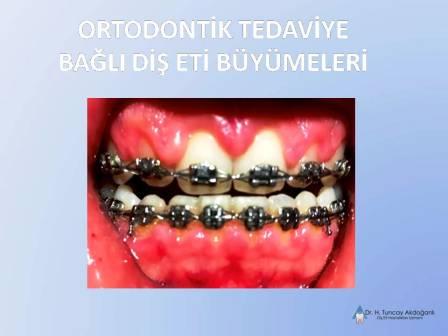 Ortodontik Tedavide Dişeti Şişliği