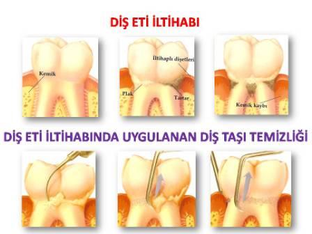 DİŞ ETİ İLTİHABI