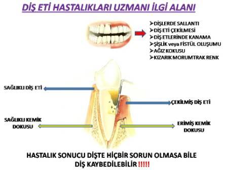 DİŞ ETİ HASTALIKLARI