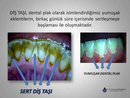 dis tasi temizligi dr tuncay akdoganli dis eti hastaliklari uzmani