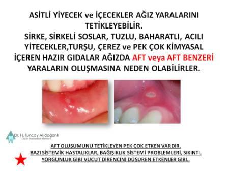 Ağız içinde aft