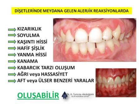 Diş etlerinde Alerji