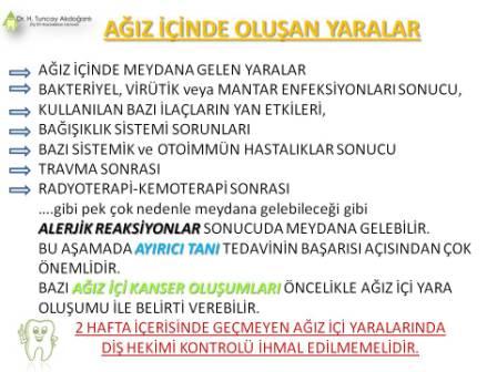Ağız içinde yara