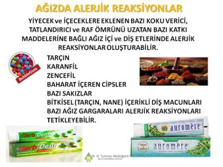 Alerjik Reaksiyonlar