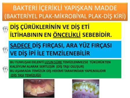 Diş eti hastalığını nedenleri