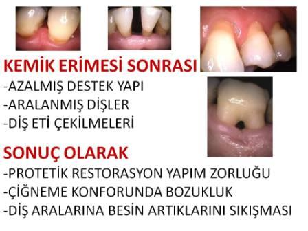 Diş Eti Hastalıkları ve Dişlerin etrafında kemik kaybı