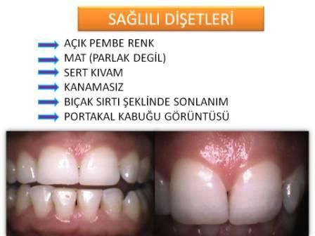 diş eti sağlığı