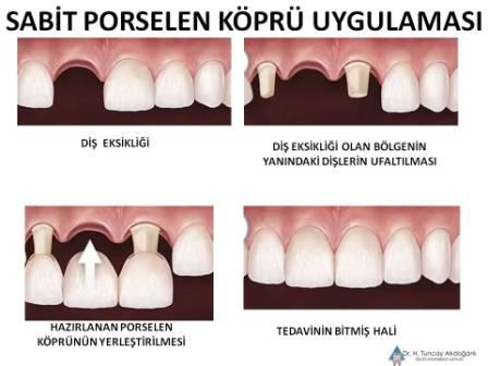 Sabit Porselen Köprü Uygulamaları