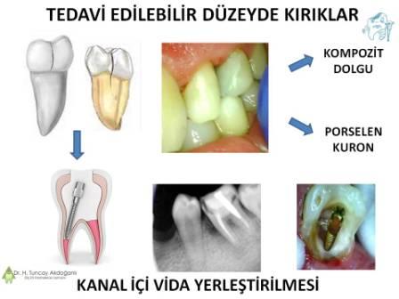 Diş kırılmalarında vidalı dolgu