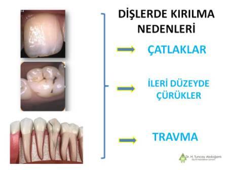 Dişlerde kırılma nedenleri