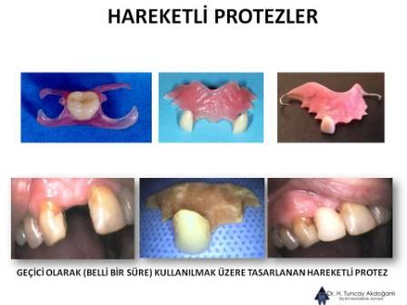 Hareketli protezler