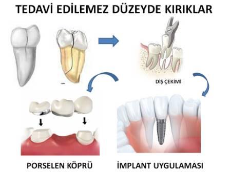 Diş çekimi sonrası uygulanan tedaviler