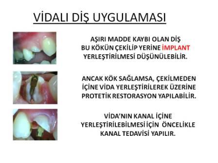 Vidalı Diş