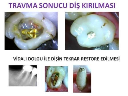 Travma sonucu diş kırılması