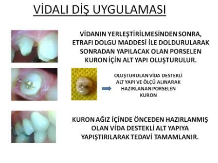 Vidalı diş