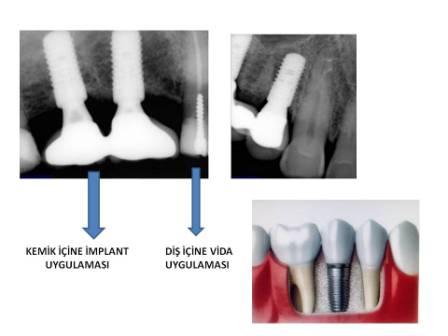 Kemik İçi İmplant Uygulamaları 