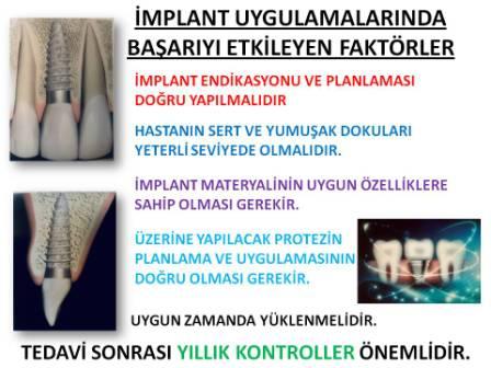 İmplant Uygulamalarında Başarı