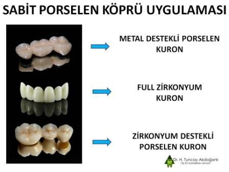 Zirkonyum Dişler