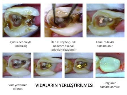 vida ile yapılan diş dolgusu