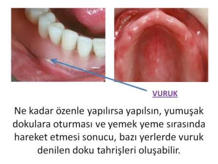 protezlerin ağız içinde oluşturduğu yara