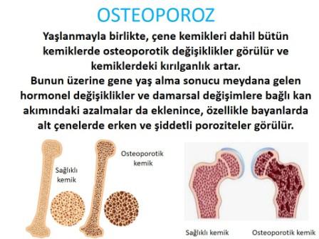 kemiklerdeki değişim sonucu görülen osteoporoz