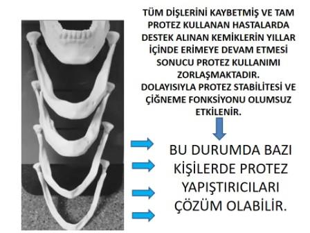 protez kullanan kişilerde kemik erimesi