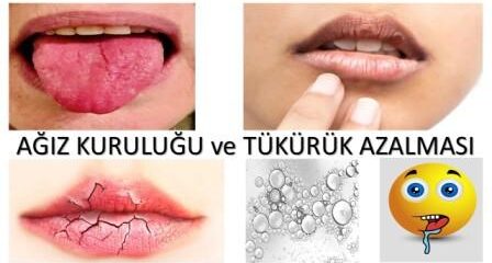 Ağız kuruluğu ve tükürük azalması