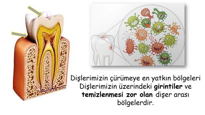 diş çürümeleri en çok nerede oluşur