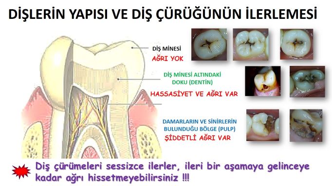 Diş çürükleri nasıl ilerler