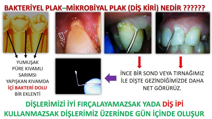 dişler neden çürür