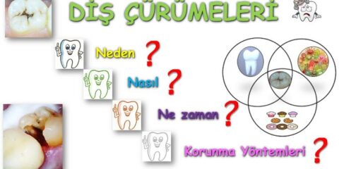 diş çürümesi
