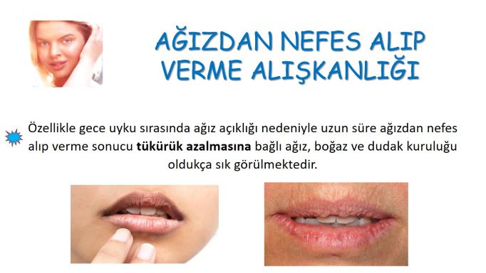 ağızdan nefes alma alışkanlığı