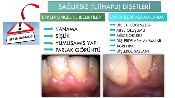 şeker hastalığı sonucu oluşan diş eti problemleri
