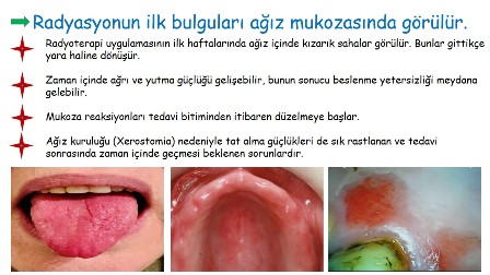 kanser hastalarında radyasyonun ağız içindeki etkileri