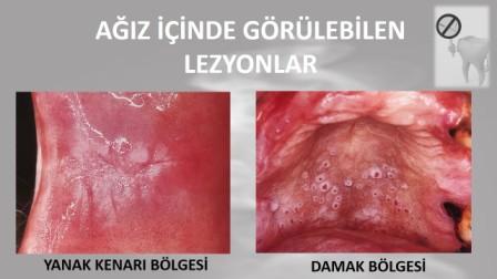 Ağız içindeki yara