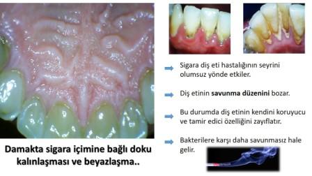 Sigara ve diş eti hastalığı